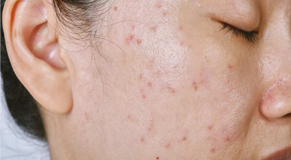 A woman with acne and acne scars