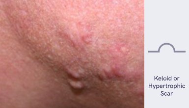 Hypertrophic Acne Scars Treatment in Singapore