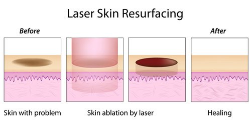 Laser Skin Resurfacing Scarring Treatment
