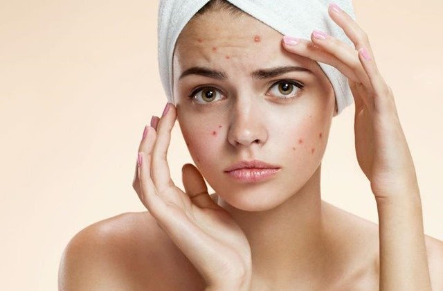 acne problems