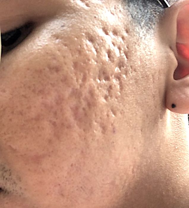 Why is Understanding your Acne Scar Depth Important?