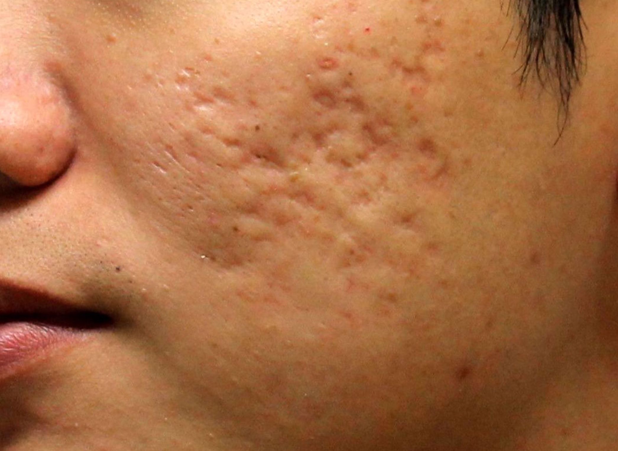 How Deep are Acne Scars?