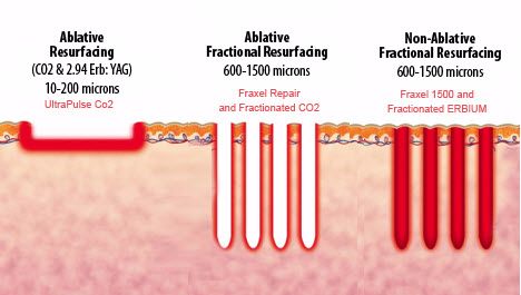 Lasers For Acne Removal - What You Need To Know