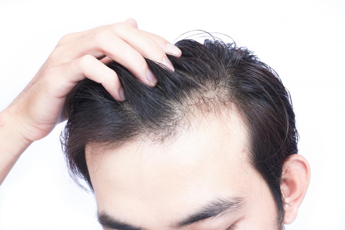 Men's Hair Loss Treatment Singapore