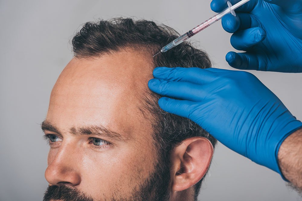 Hair Loss Treatment in Singapore - What's getting results in 2019