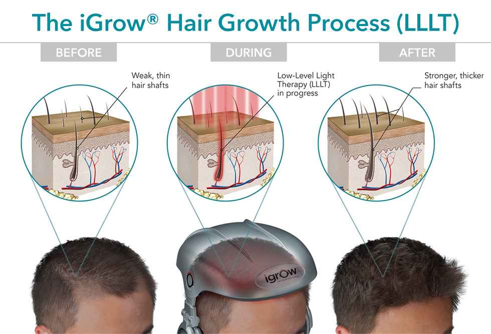iGrow Hair Growth Process or LLLT