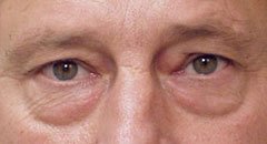 lower eyelid complex male