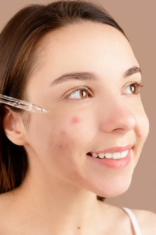 Alternatives to Laser Treatment for Acne