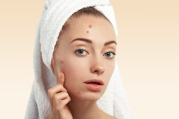 A woman with towel on head and pimples on face