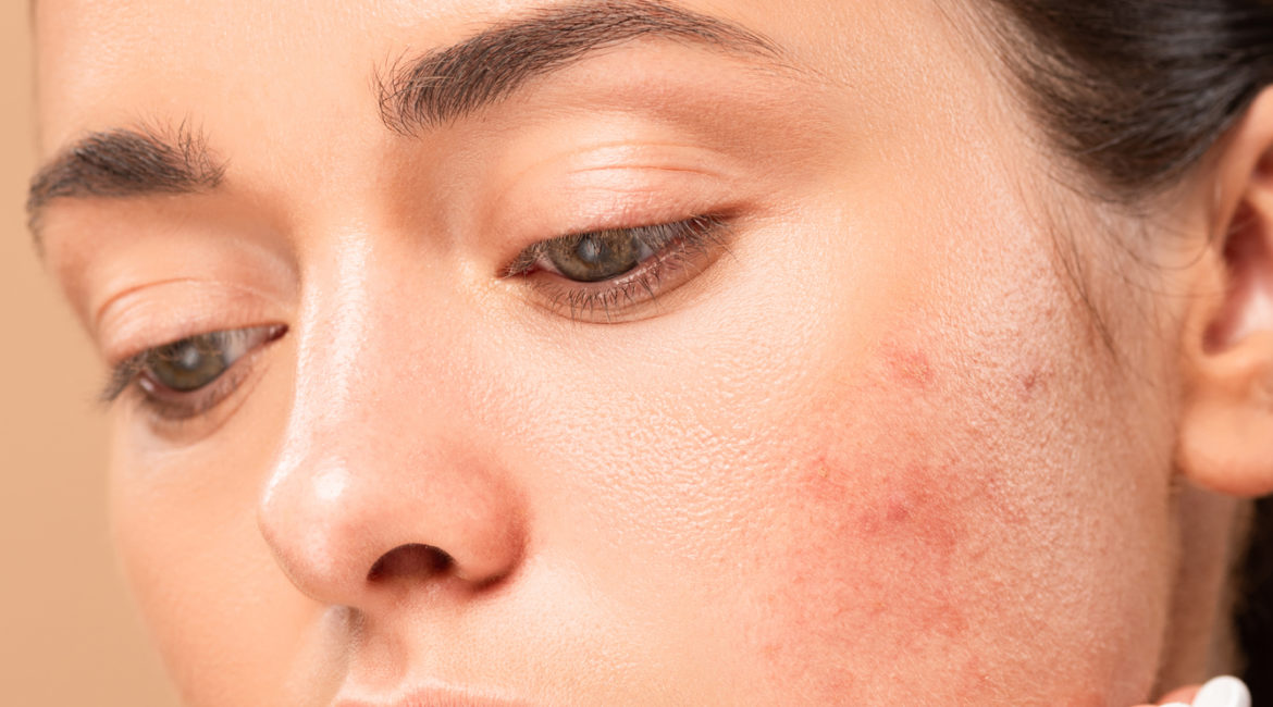 Treatment ☝️ 2021 scars dating best acne with Home Remedies