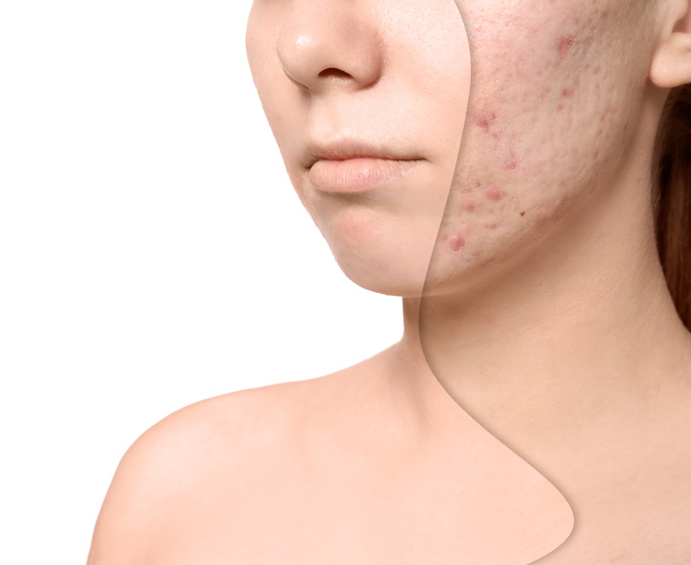 acne scar treatment before and after