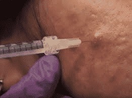 Acne Intralesional Steroid Injections
