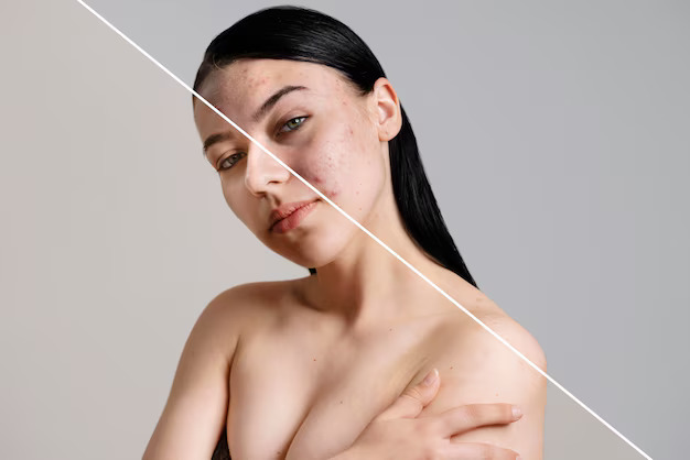 Before and after portrait of woman with acne