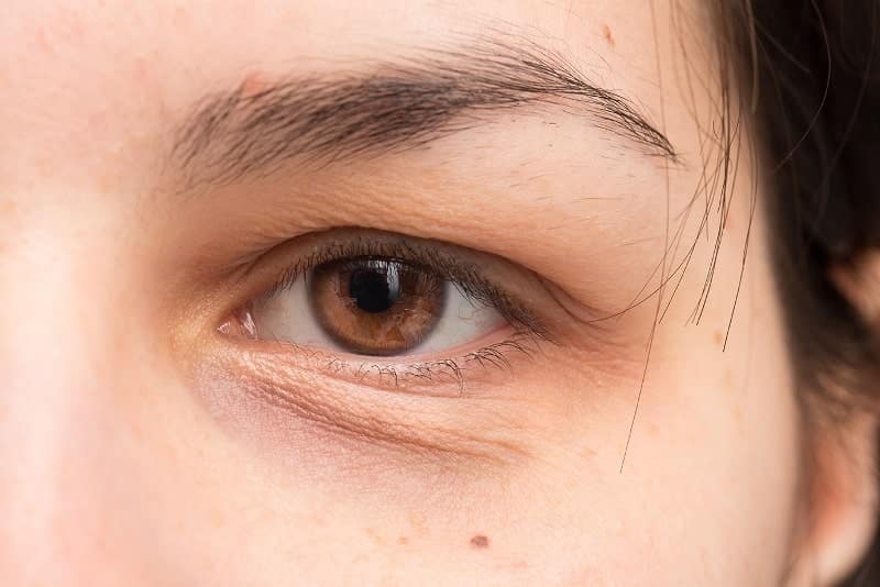 what causes eye bags