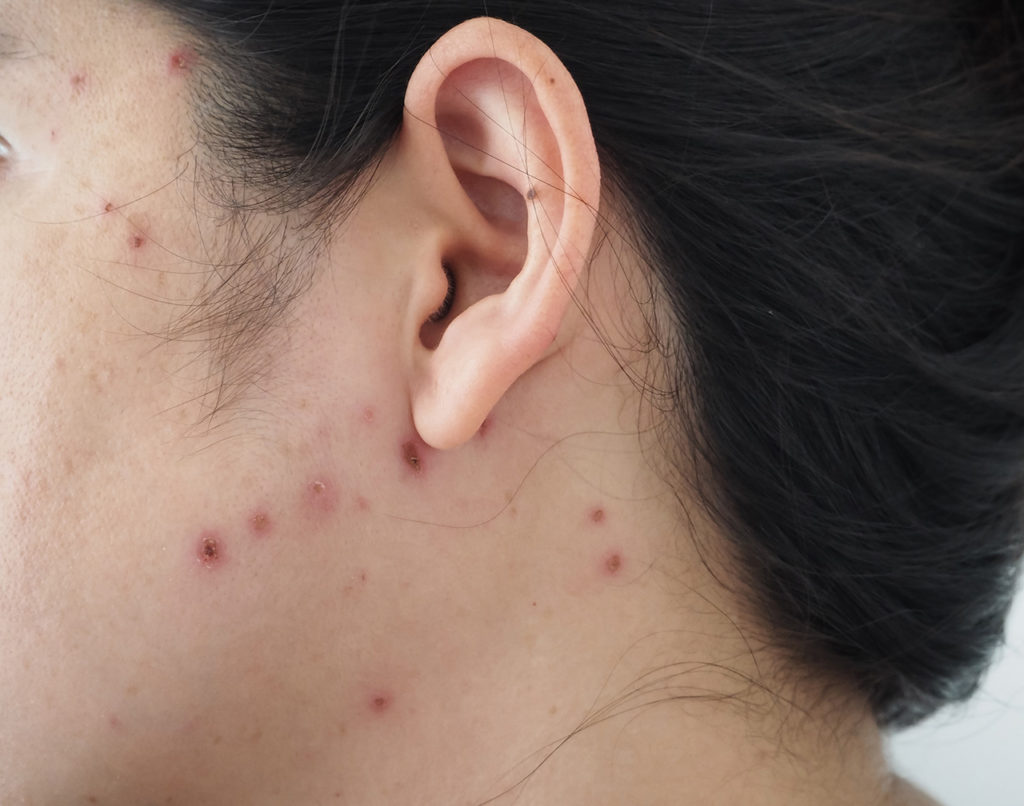 Chicken pox scars on a woman's face and neck.