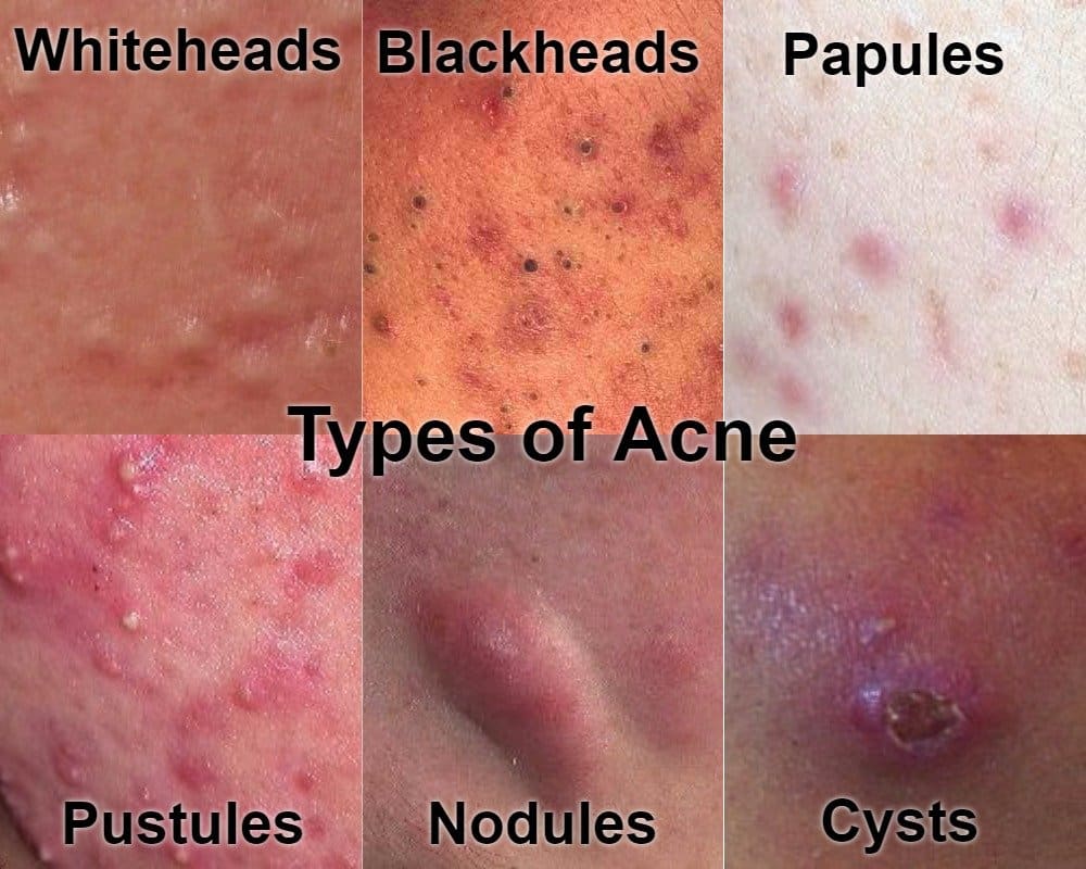 Types of Cystic Acne