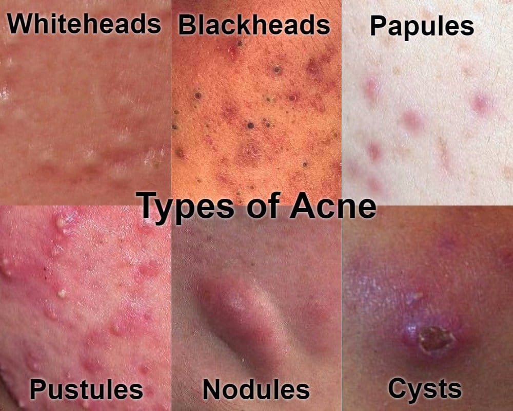 Cystic Acne Treatment Singapore Advice From A Doctors Perspective