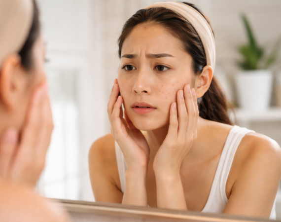 Erbium YAG Laser for Superficial Atrophic Scarring