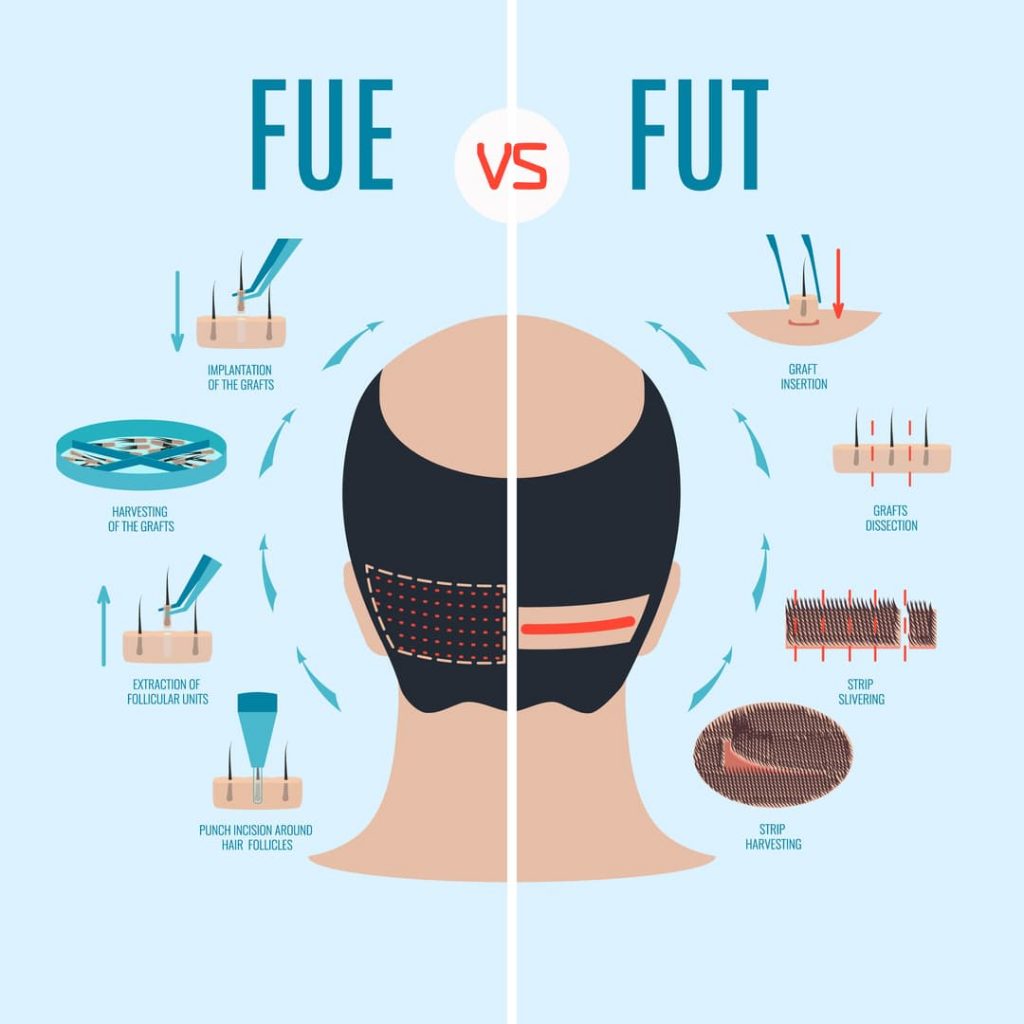 FUE and FUT Hair Transplant Comparison