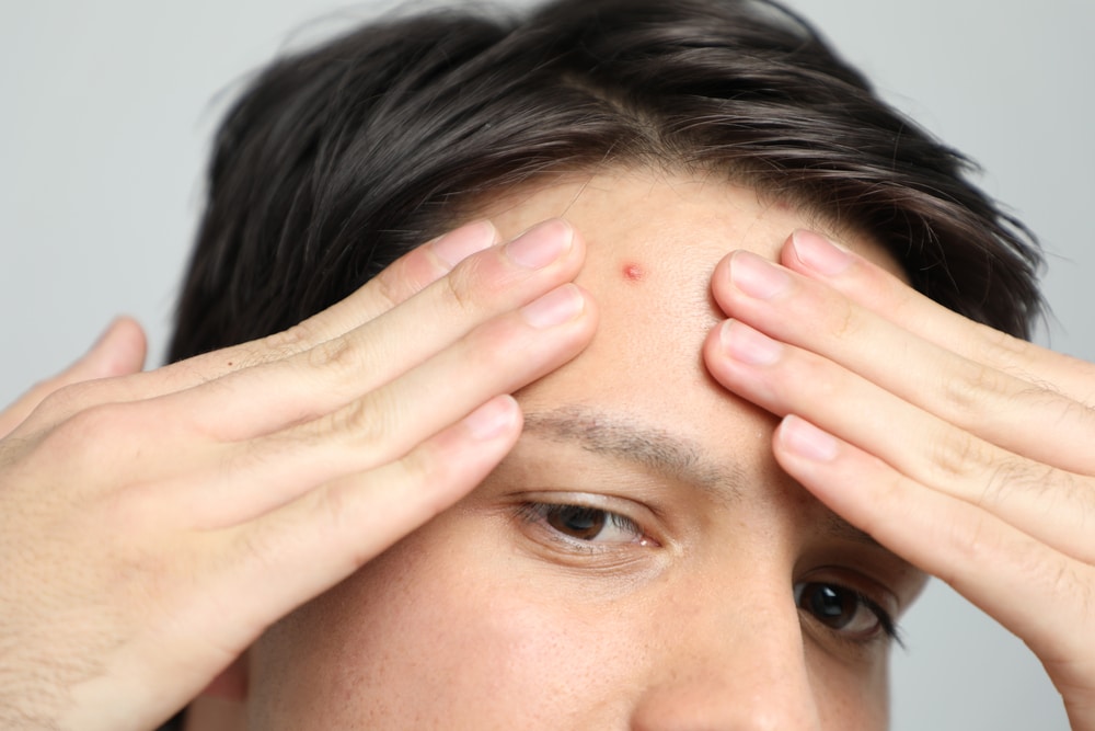 Cystic Acne on the Forehead