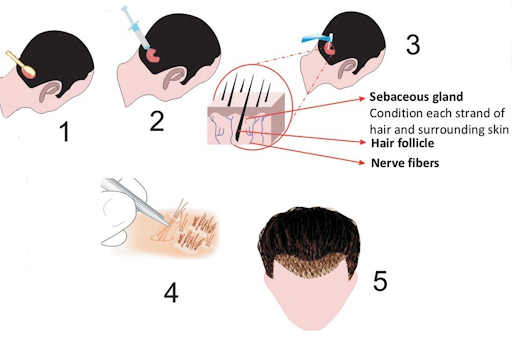 Hair Transplant Cost in Singapore - 2019 Review