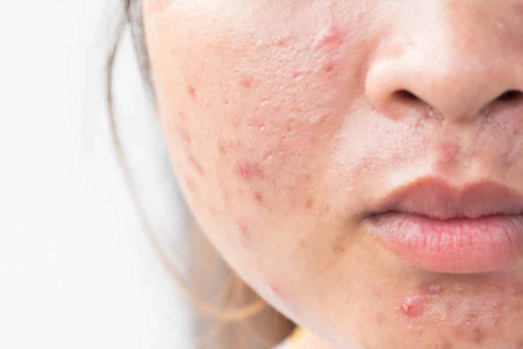 Hormonal Acne Treatments in Singapore