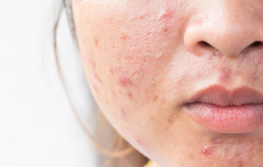 cystic acne on cheeks causes and treatments