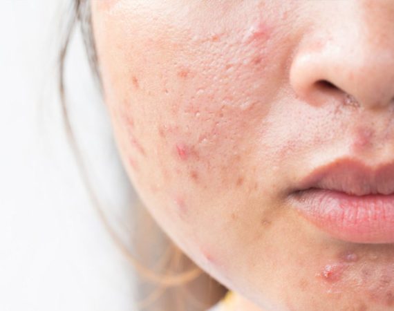 cystic acne on cheeks causes and treatments