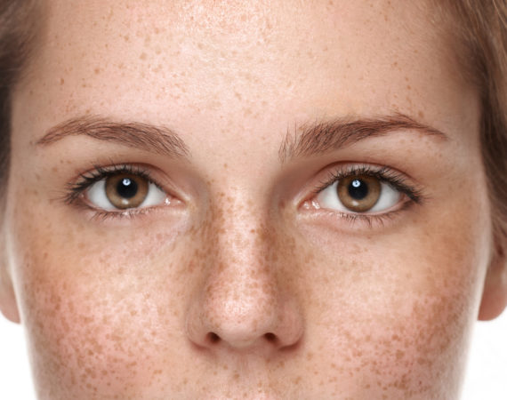 How To Get Rid of Pigmentation