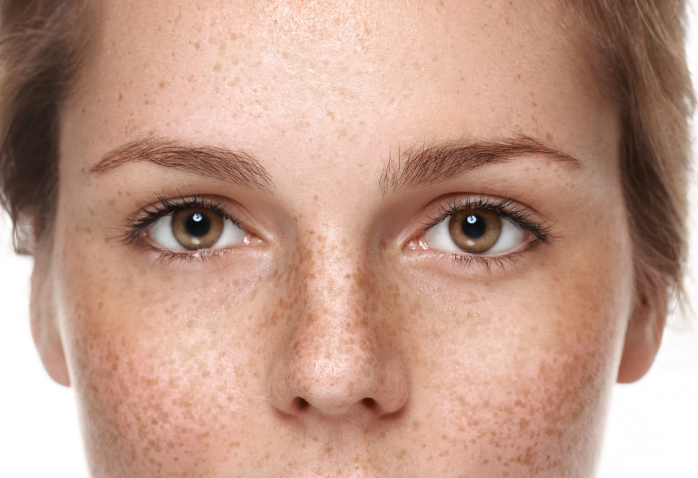 How To Get Rid of Pigmentation