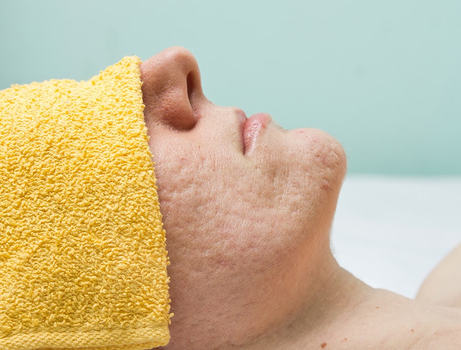 acne scar patient with towel over eyes