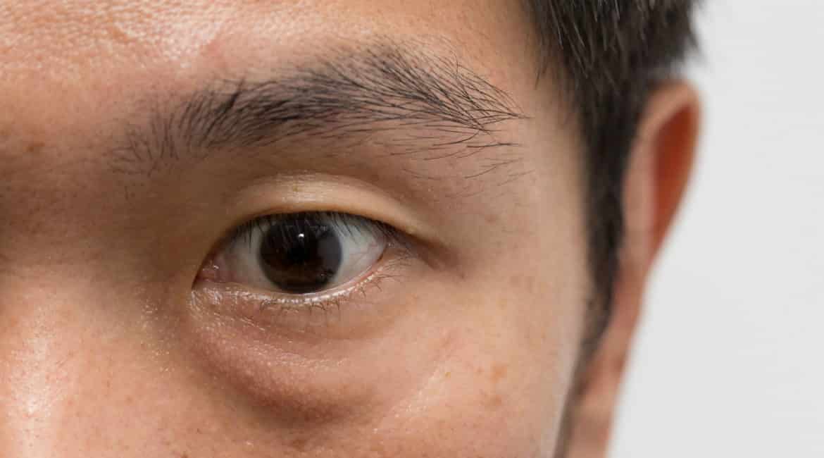 how to get rid of eye bags in singapore