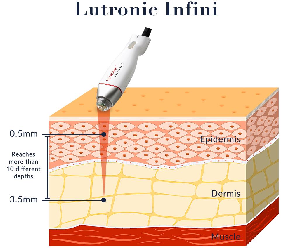INFINI RF targets skin layers