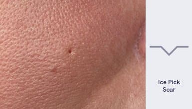 Ice Pick Acne Scars Treatment in Singapore