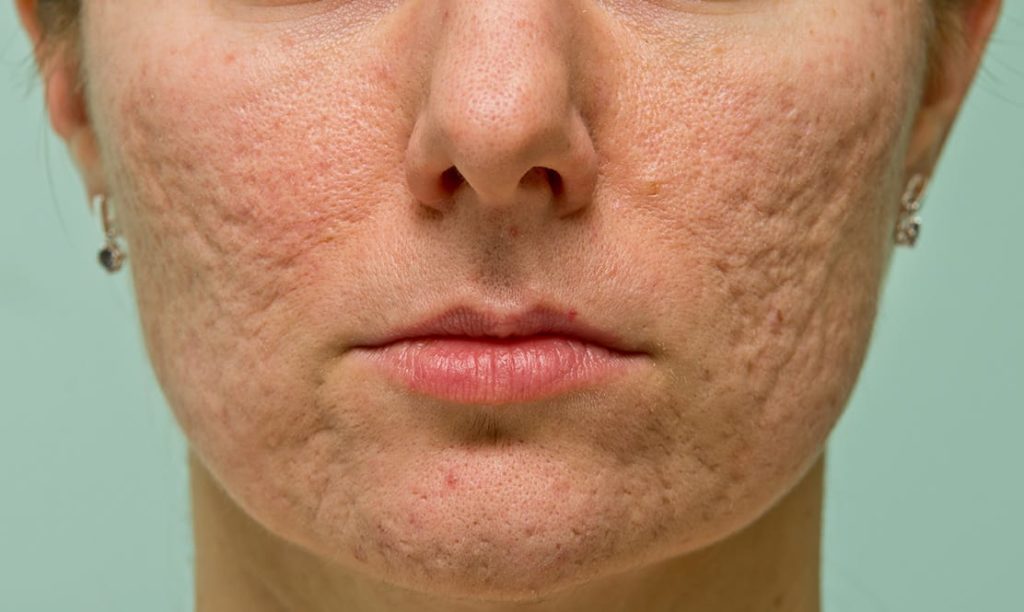 Ice pick acne scar on a woman's cheeks and chin.