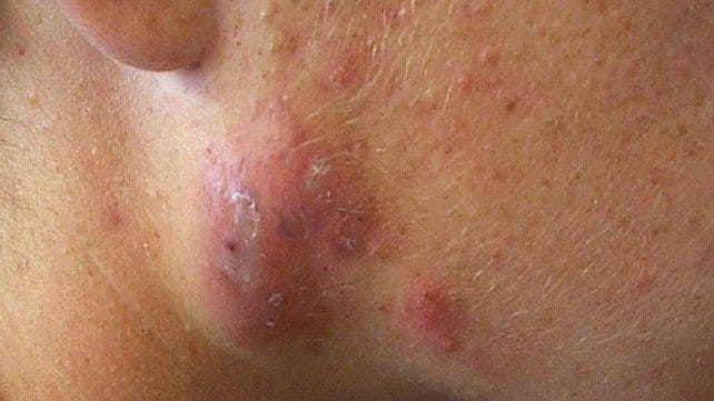 Large, inflammed Cystic Acne