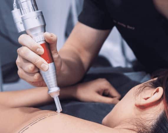 Laser Tattoo Removal in Singapore