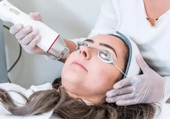 Microneedling Radiofrequency (MNRF) for Ice Pick Scar Remodelling