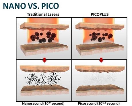 Nano vs Pico Laser