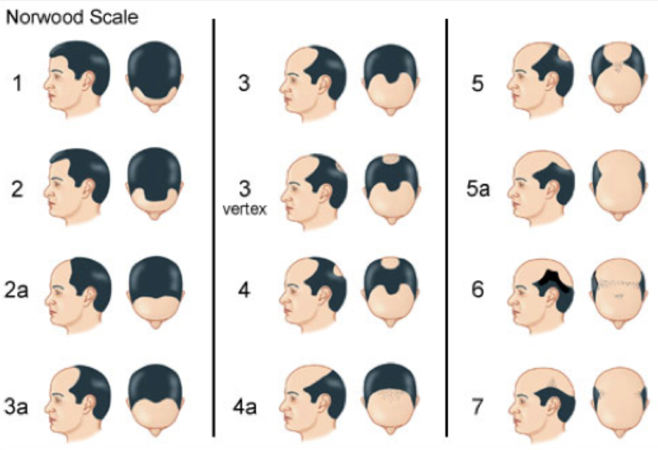 Norwood Scale for Pattern Male Hair Loss