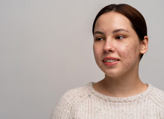 Person dealing with rosacea