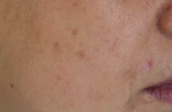 Post Inflammatory Hyperpigmentation Singapore