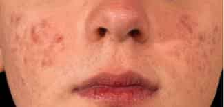 post-acne-hyperpigmentation-singapore