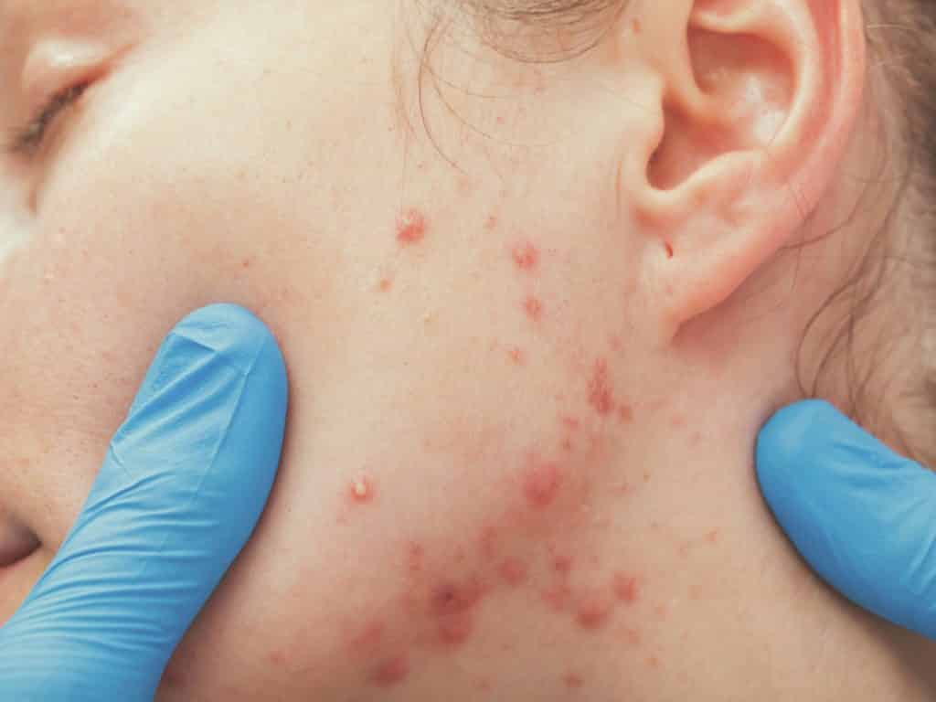 Severe Cystic Acne Treatment in Singapore
