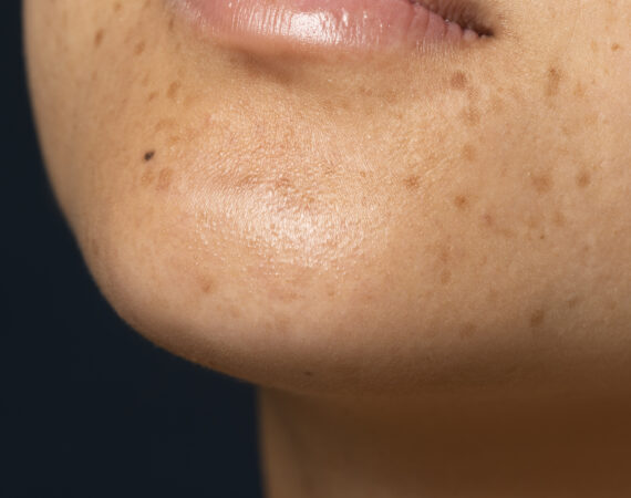 Side-view of woman with Pigmentation