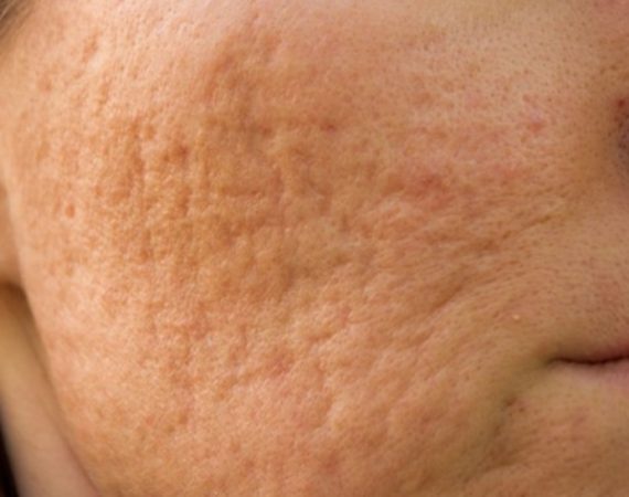 acne scars