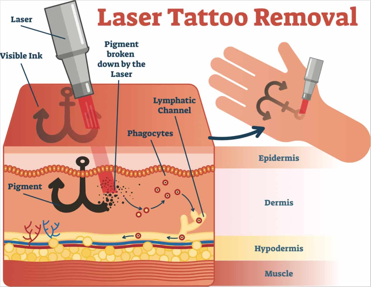 Tattoo Removal Laser in Singapore