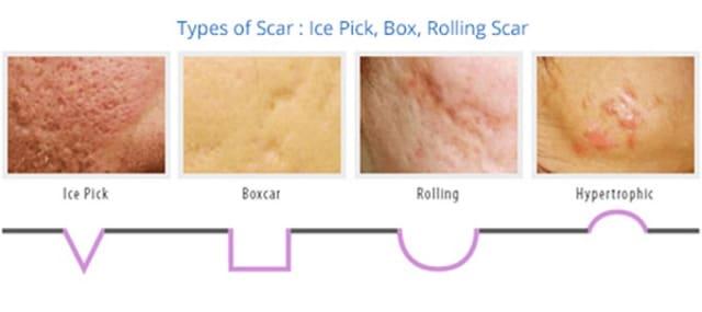 Types of Acne Scar: Ice Pick, Box, Rolling, and Hypertropic