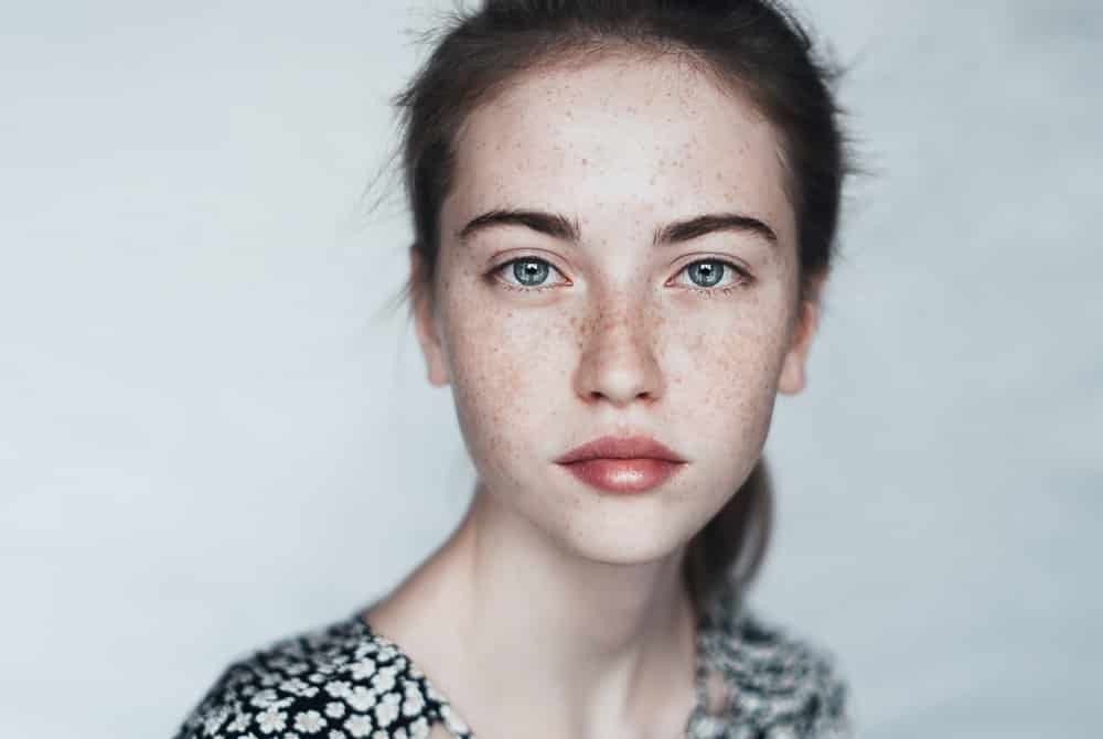 What Causes Freckles