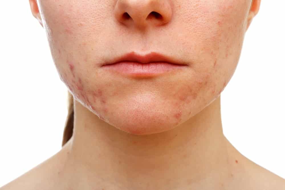 where hyperpigmentation appears